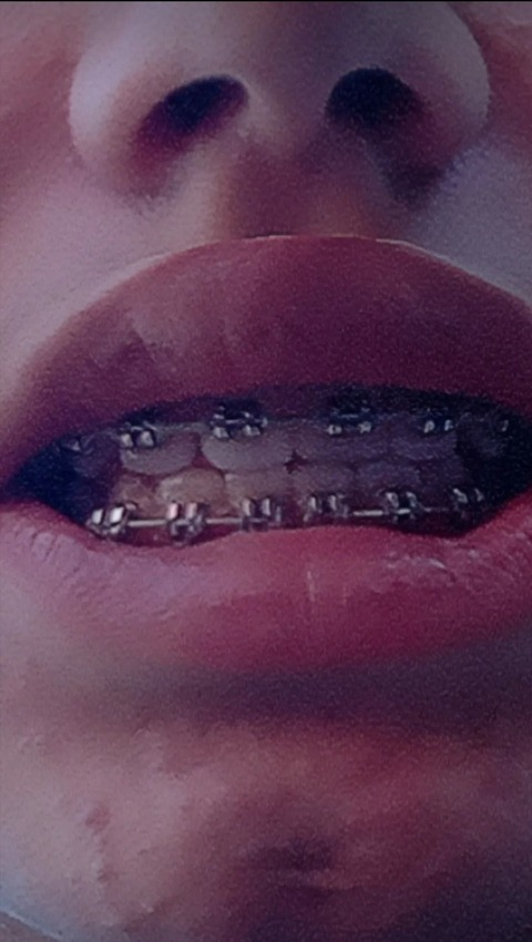 bracesfetish OnlyFans - Free Access to 32 Videos & 49 Photos Onlyfans Free Access